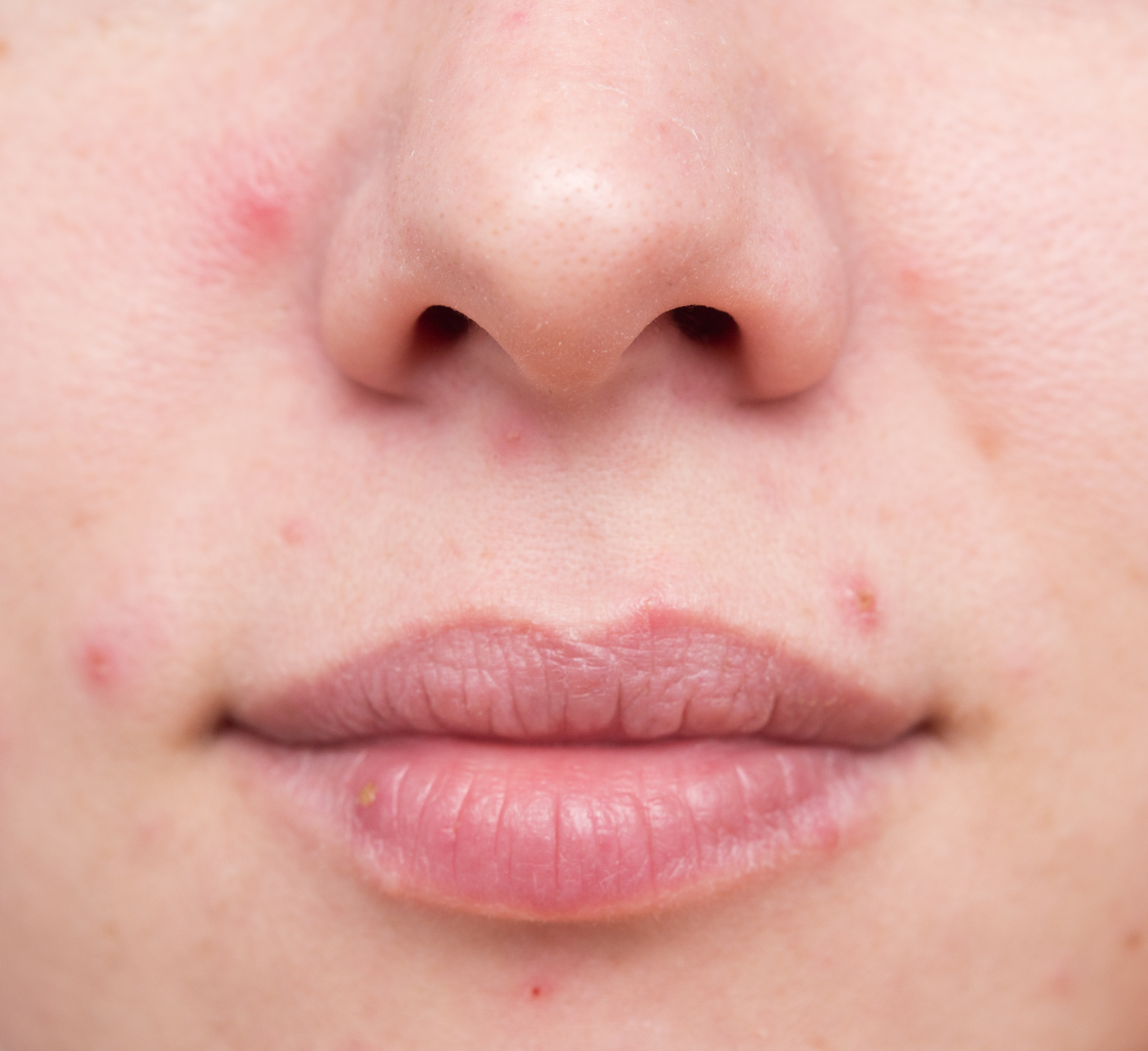 Stress Acne What It Is Its Causes And How You Can Banish It