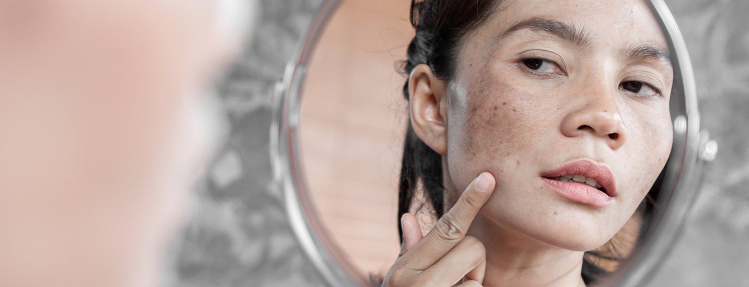 The 19 Best Melasma Creams - The Dermatology Review