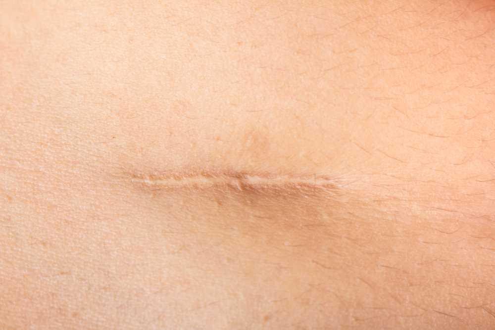 A Guide to Scars, Types, and Treatment Options - The Dermatology Review